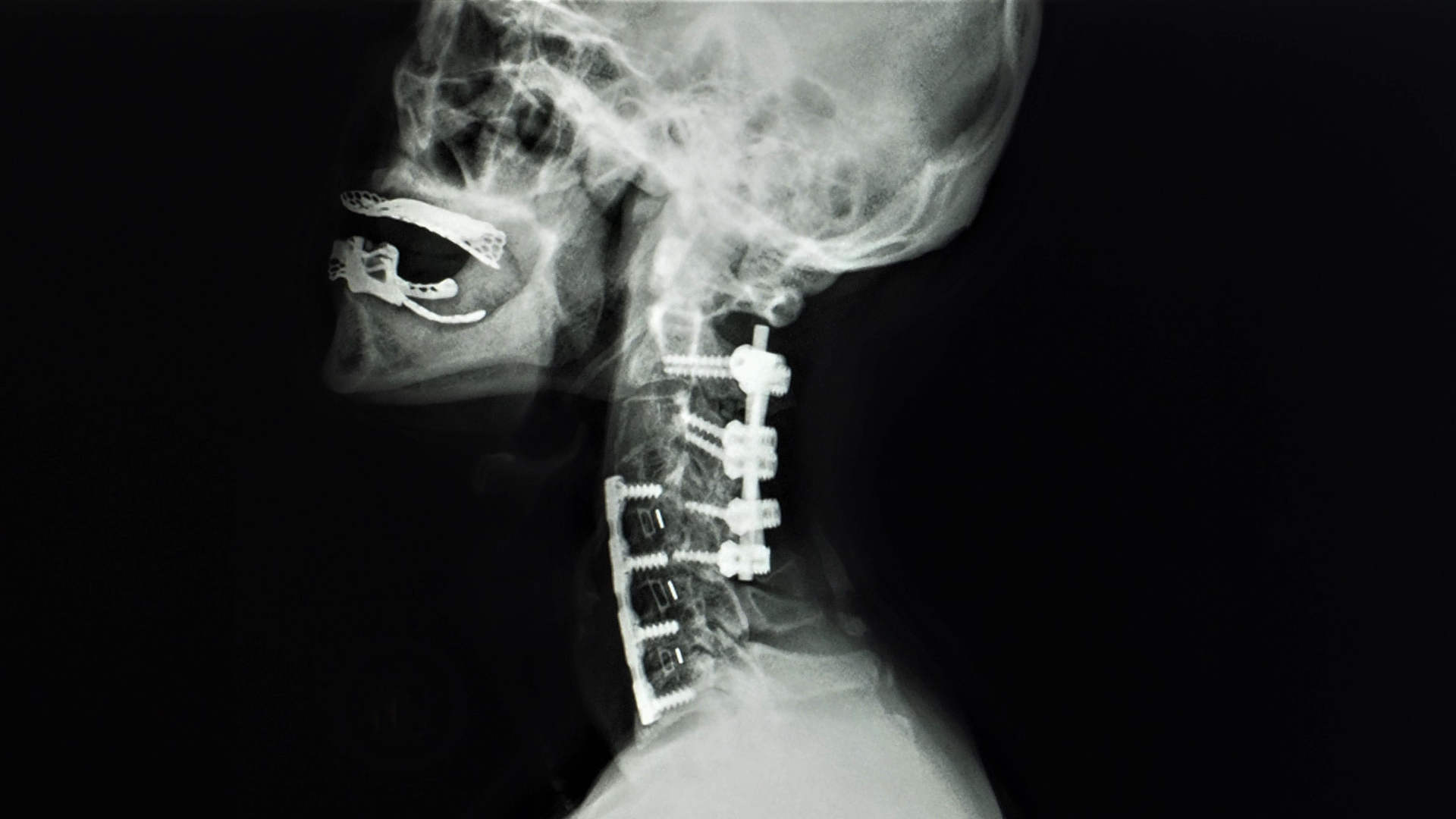 Cervical radiograph showing anterior and posterior fixation