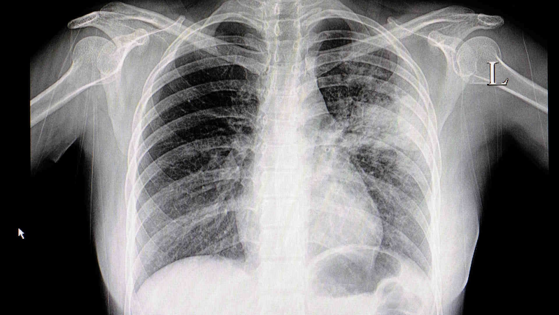CXR of a lobar pneumonia