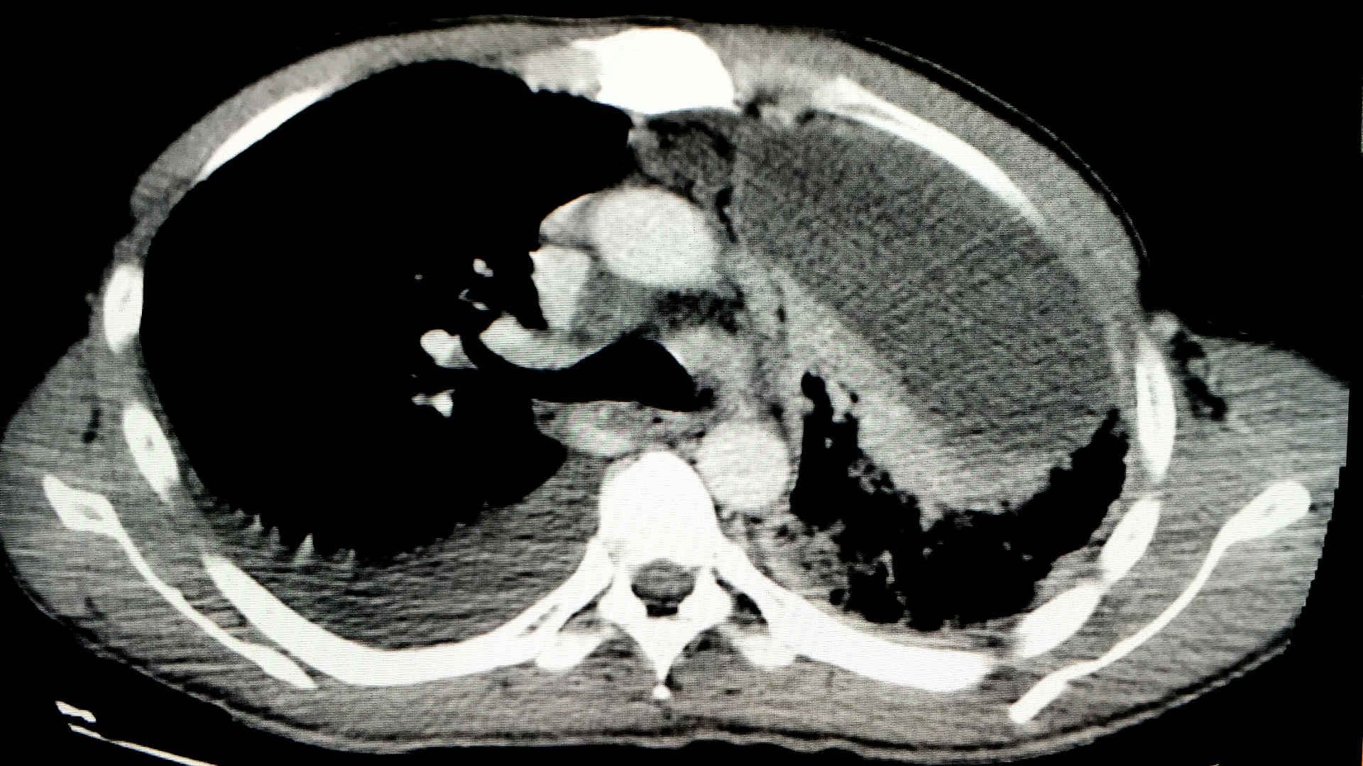 CT scan showing a large left sided lung abscess