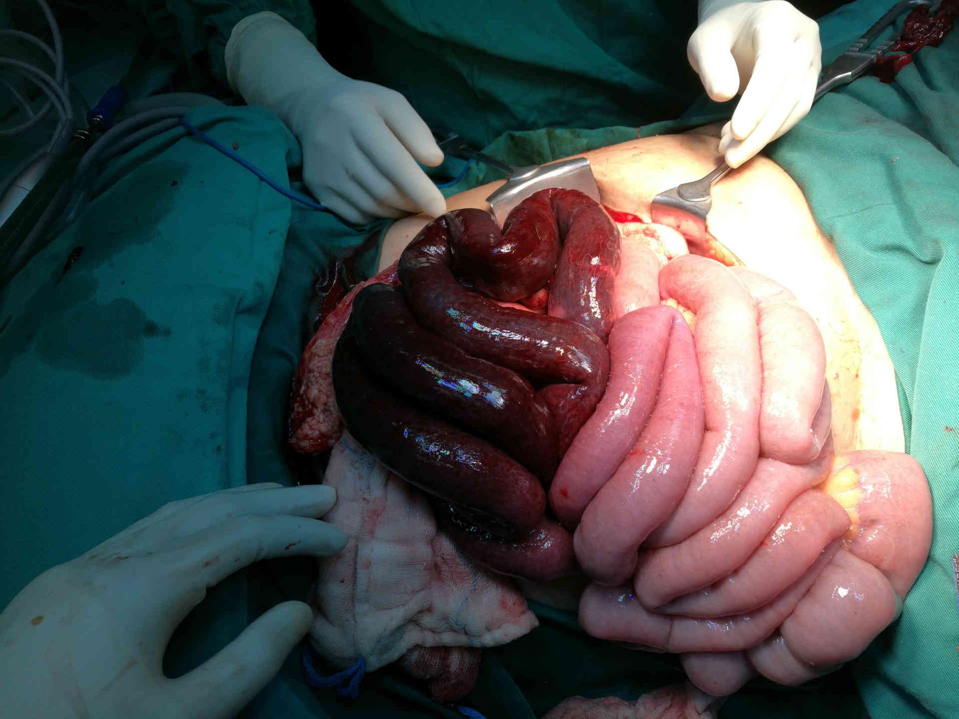 Ischaemic bowel at laparotomy