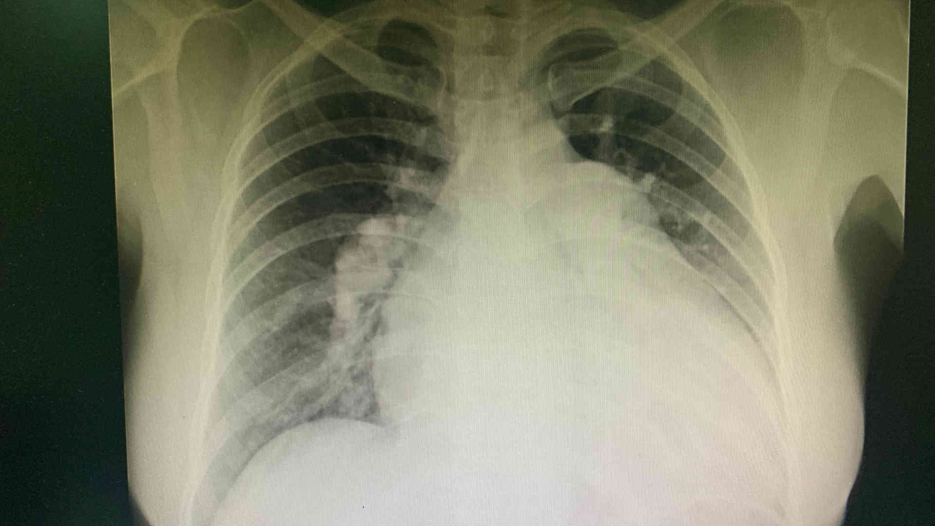 Cardiomyopathy on chest x-ray