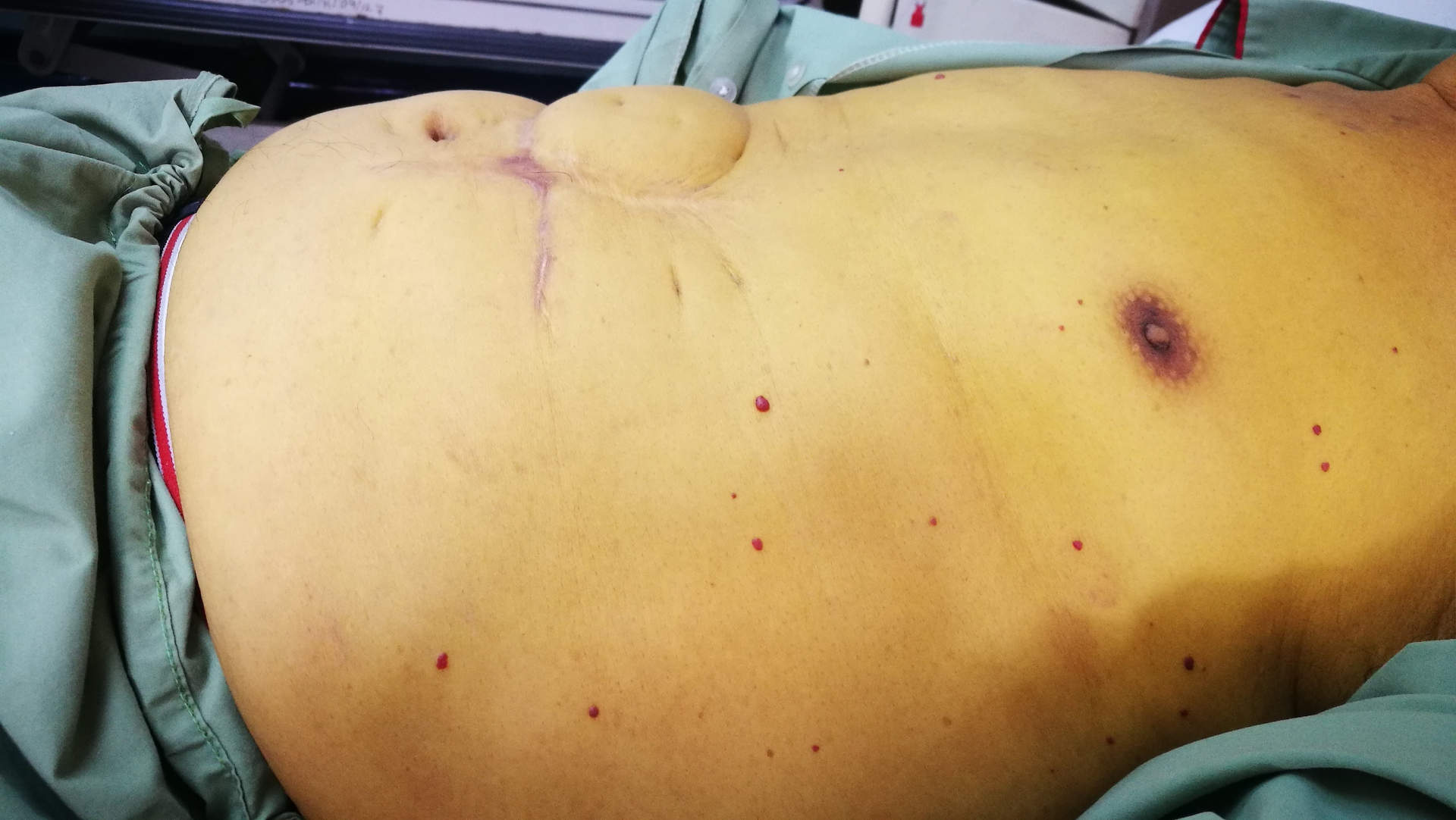 Jaundiced abdomen