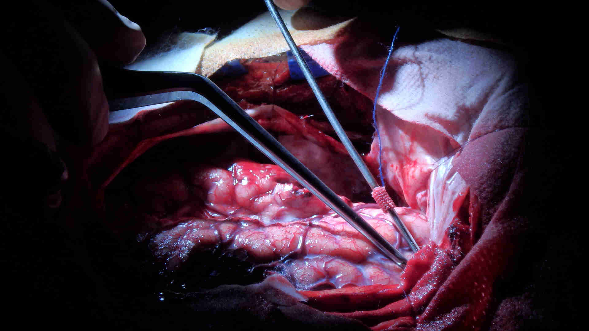 Neurosurgical clipping of a subarachnoid haemorrhage aneurysm