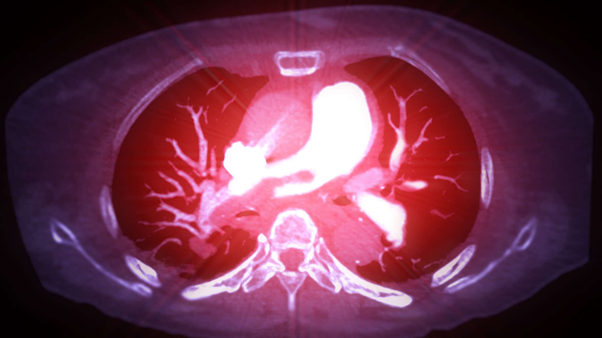 CT showing a PE
