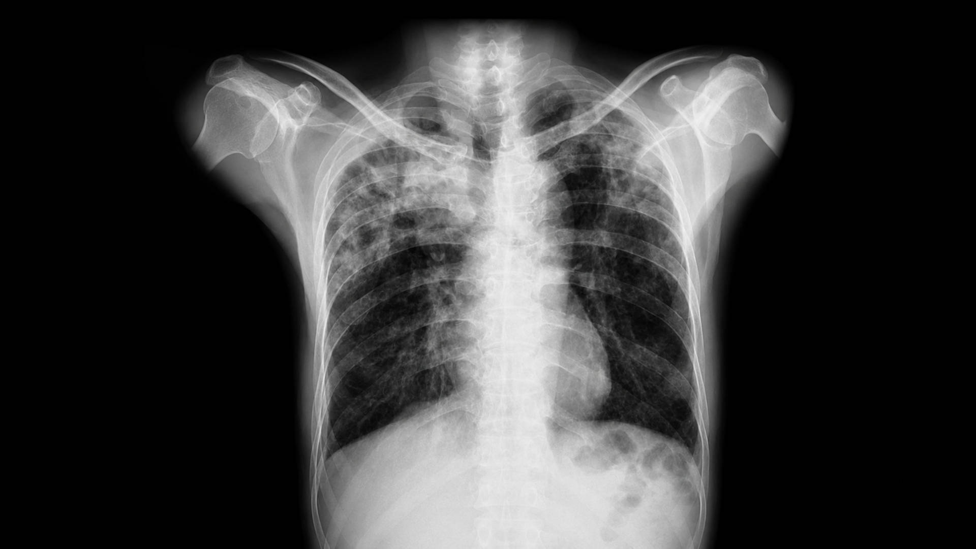 Apical TB on chest radiograph
