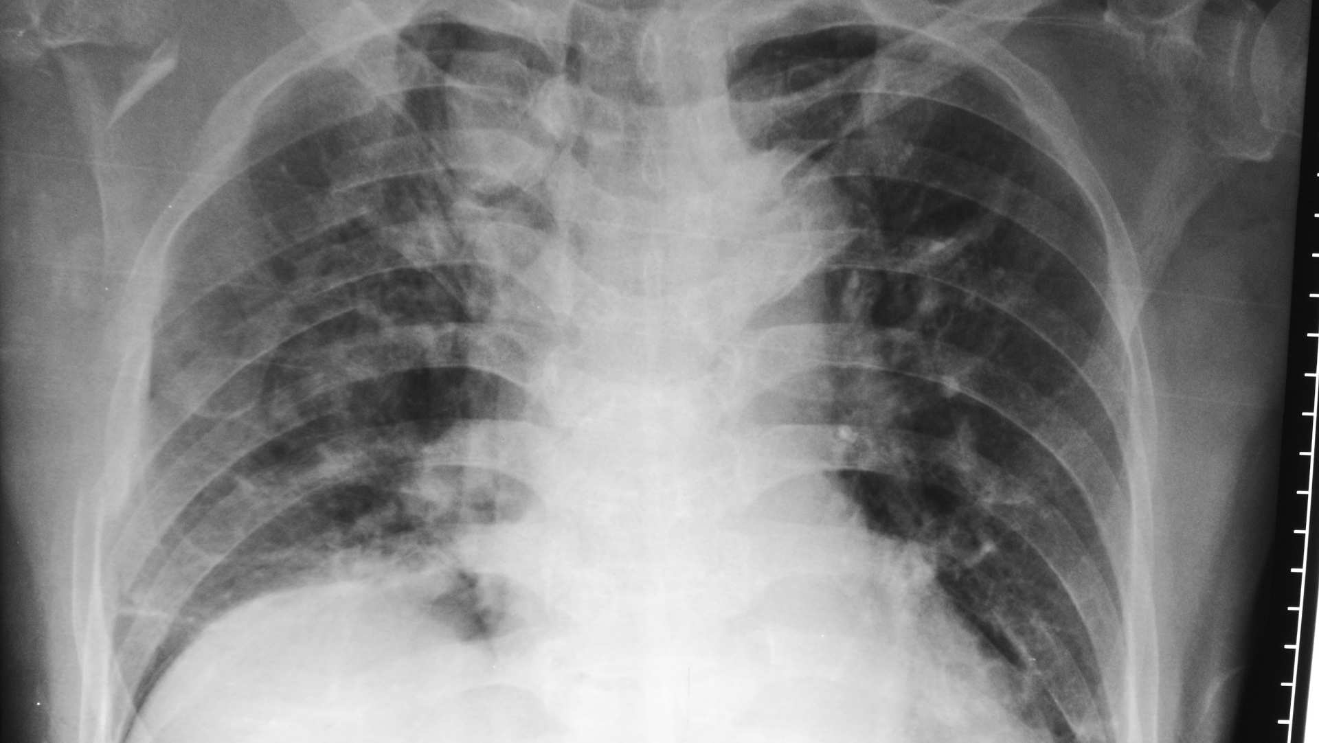 Chest radiograph showing rib fractures