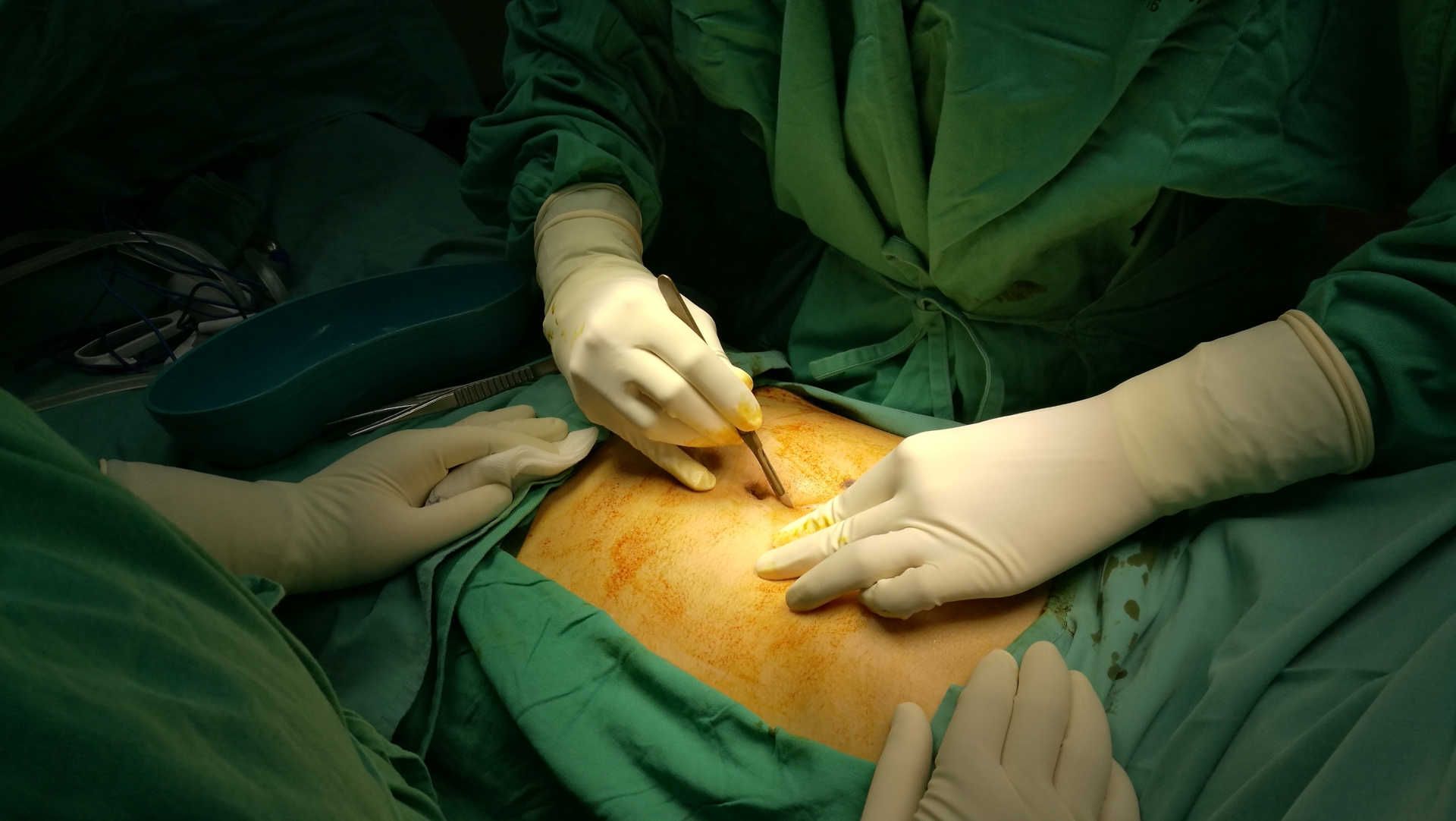 Skin incision at laparotomy