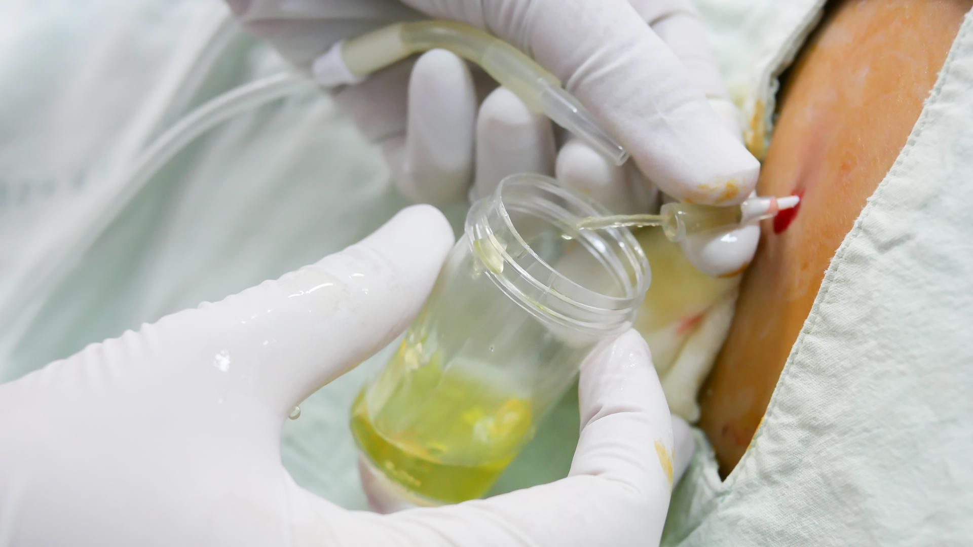 COVID-19 pneumonia on CT