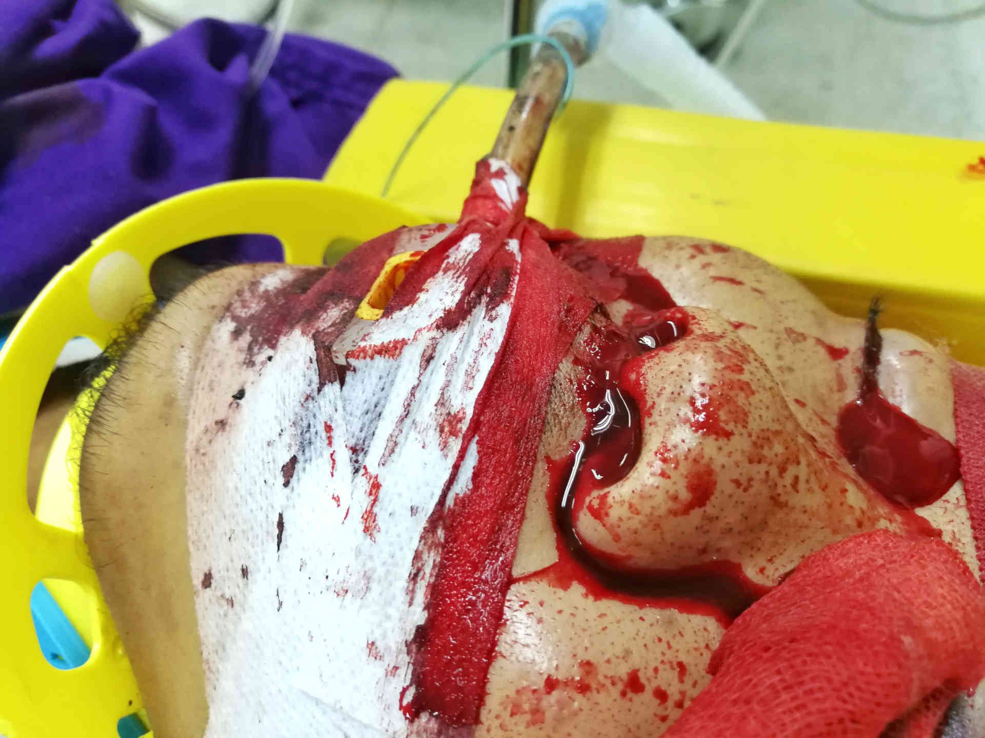 Ventilated patient in the ICU