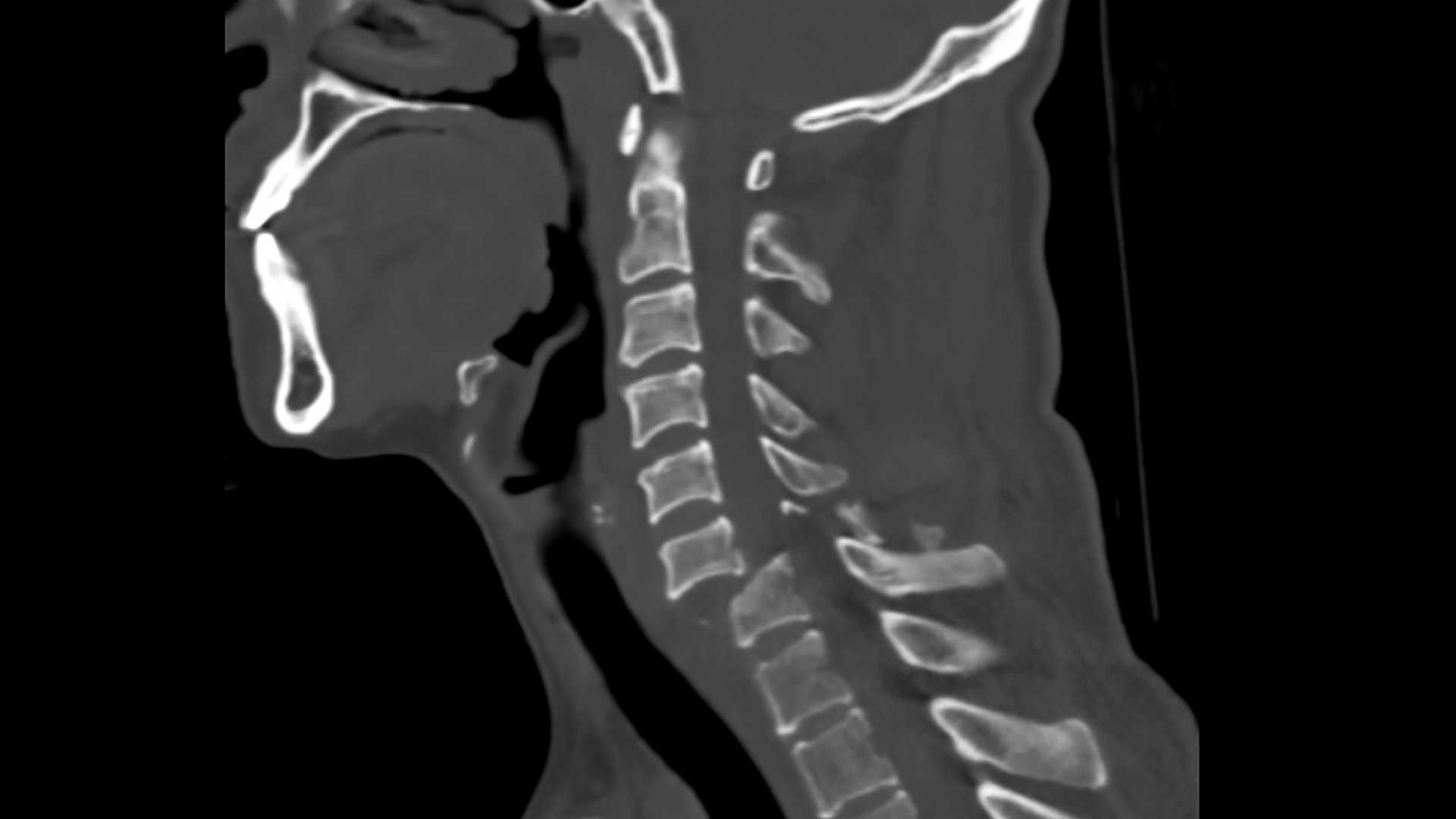 MRI showing traumatic spinal cord injury