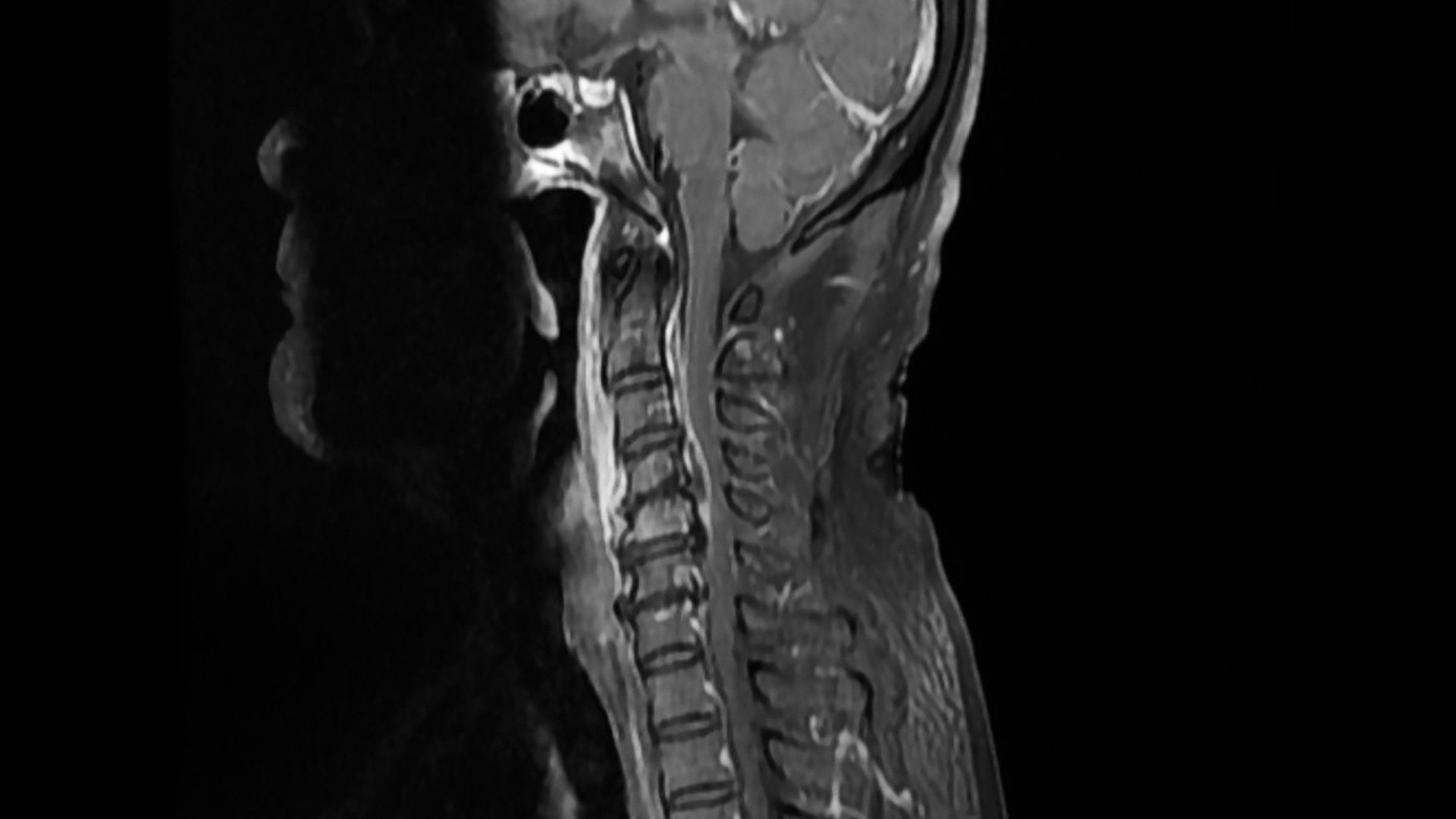 MRI of spinal epidural abscess